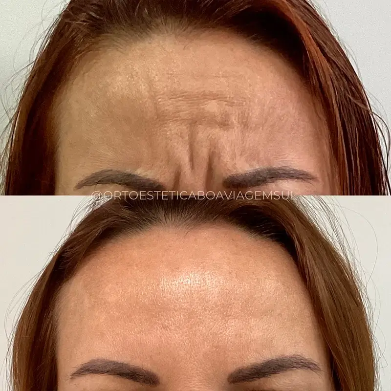 carrossel-botox-3