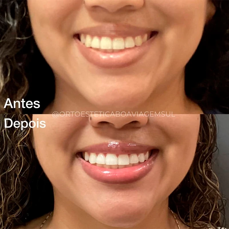 carrossel-clareamento-1