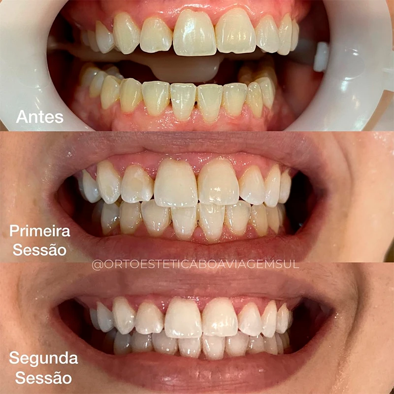 carrossel-clareamento-2