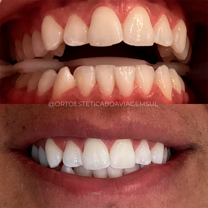 carrossel-clareamento-3