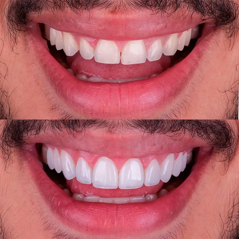 carrossel-facetas_resina-2