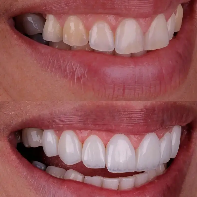 carrossel-facetas_resina-3