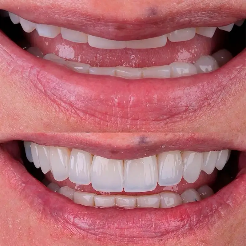 carrossel-facetas_resina-4