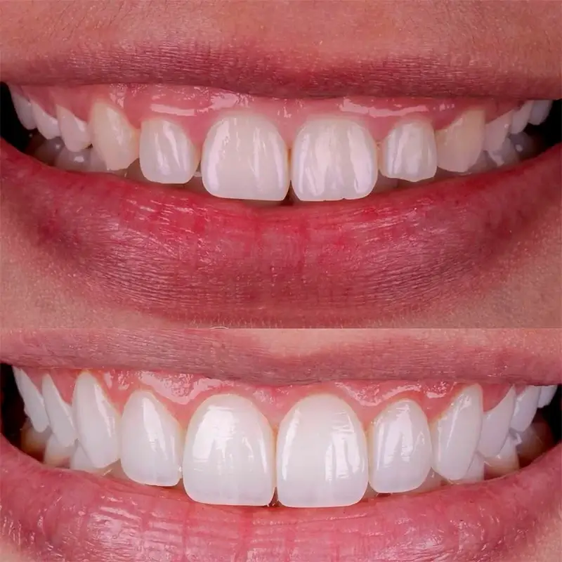 carrossel-facetas_resina-5