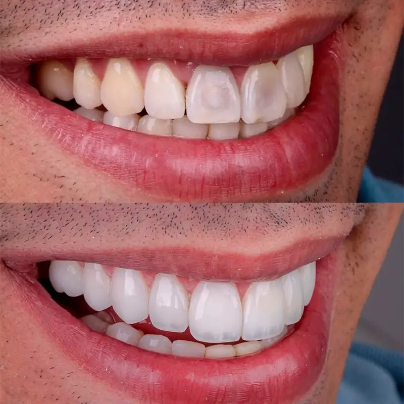 carrossel-facetas_resina-6