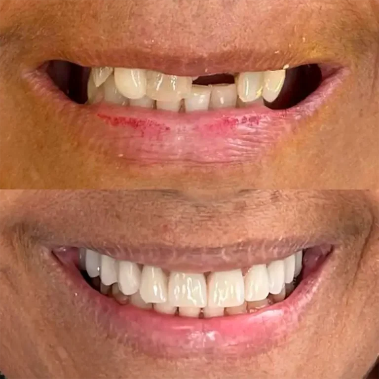 carrossel-implantes-dentarios-2