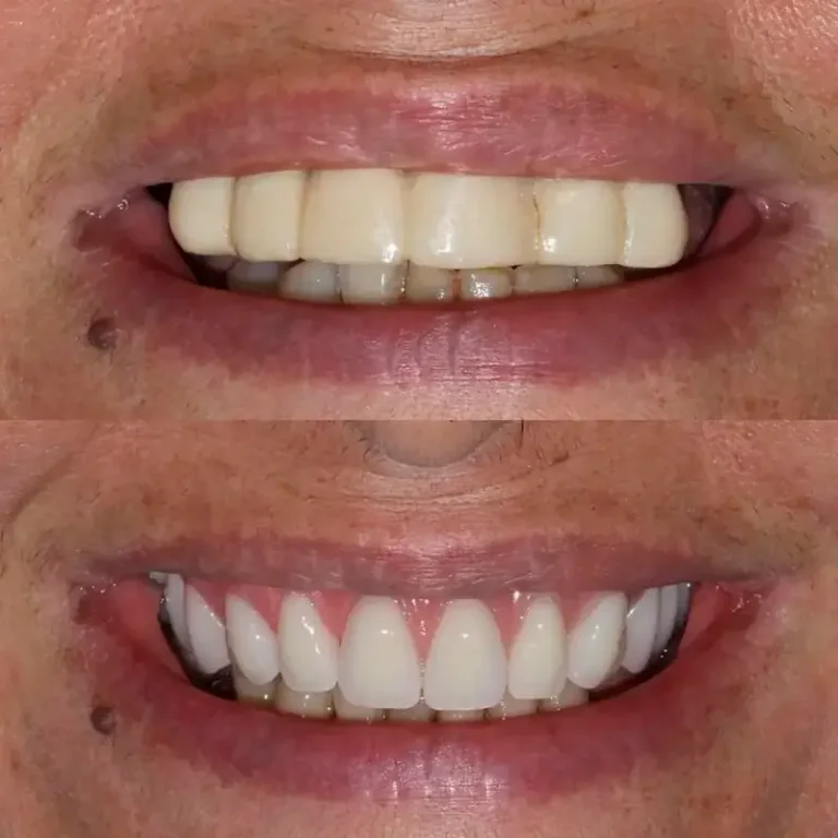 carrossel-implantes-dentarios-3