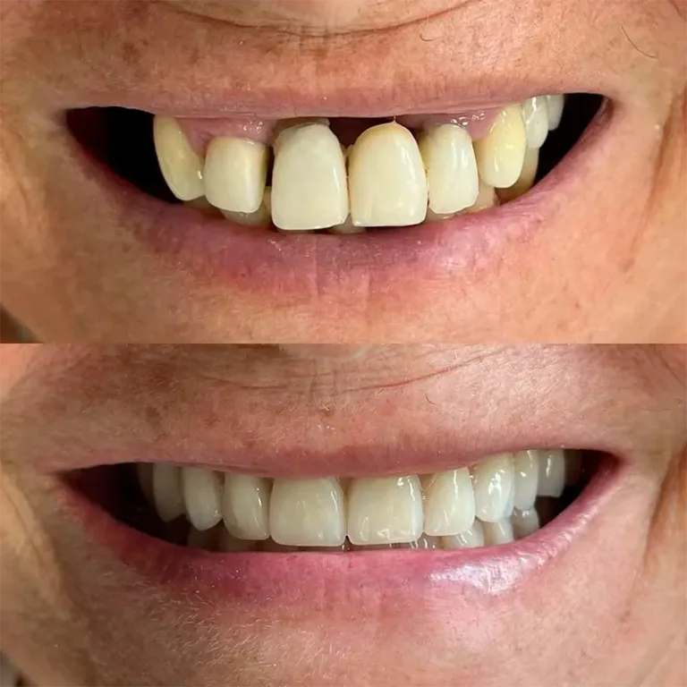 carrossel-implantes-dentarios-4