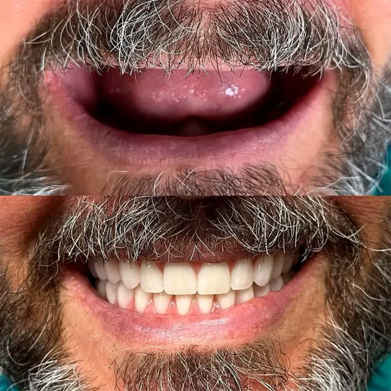 carrossel-implantes-dentarios-6