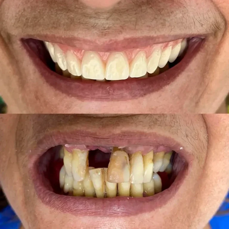 carrossel-protese-fixa-1