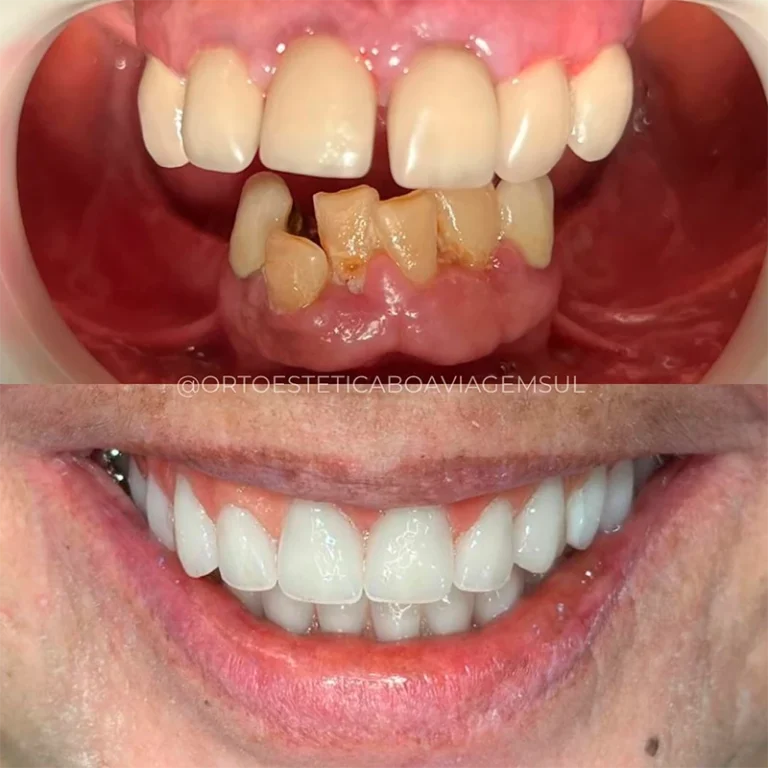 carrossel-protese-fixa-2