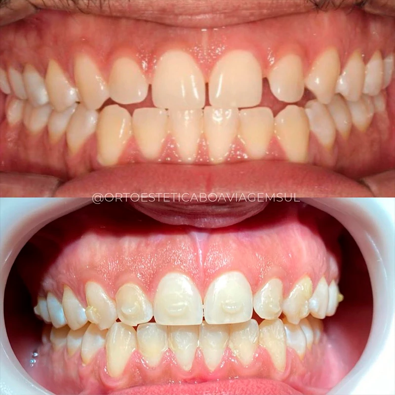 carrossel-aparelho-invisivel1