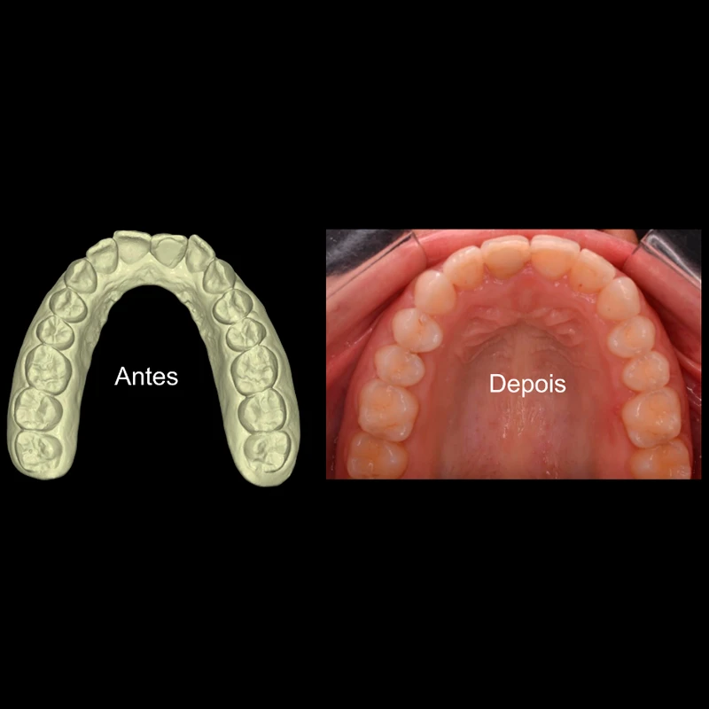 carrossel-aparelho-invisivel3