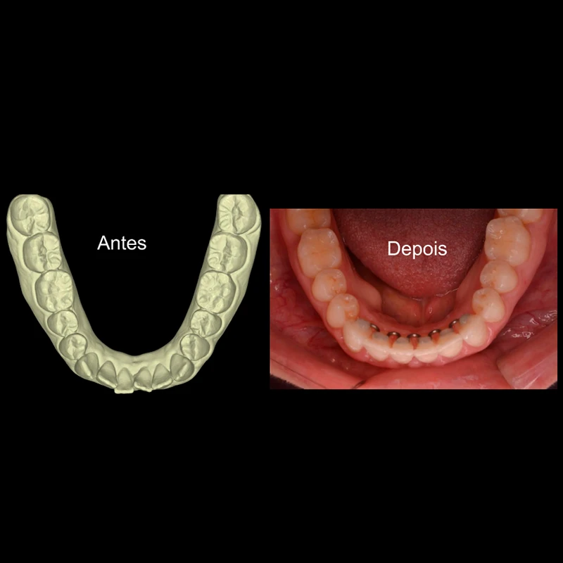 carrossel-aparelho-invisivel4