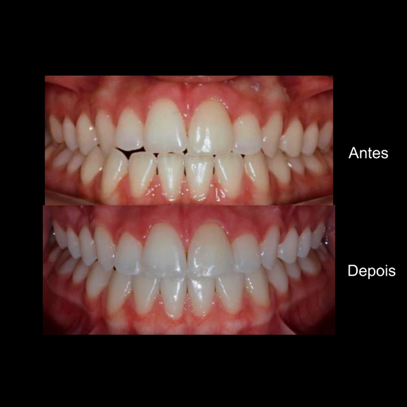 carrossel-aparelho-invisivel5