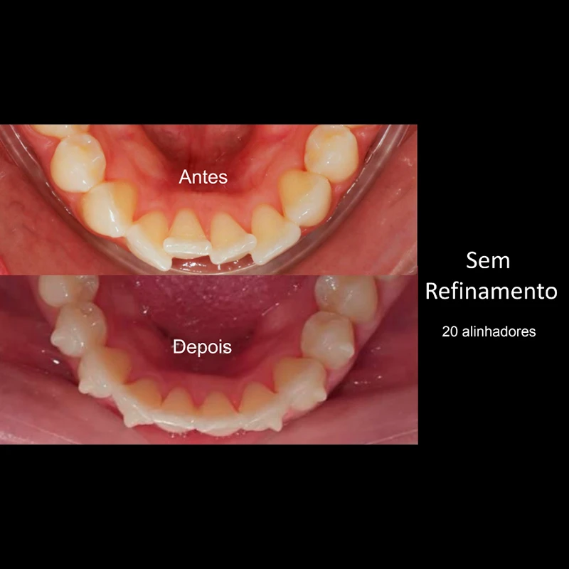 carrossel-aparelho-invisivel6