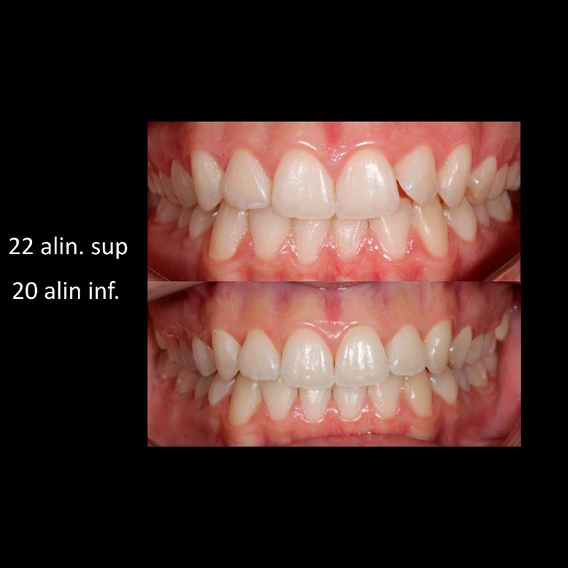 carrossel-aparelho-invisivel7