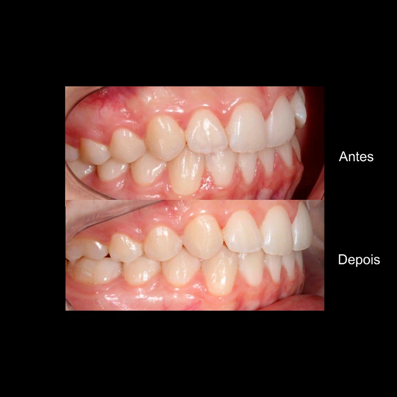 carrossel-aparelho-invisivel8
